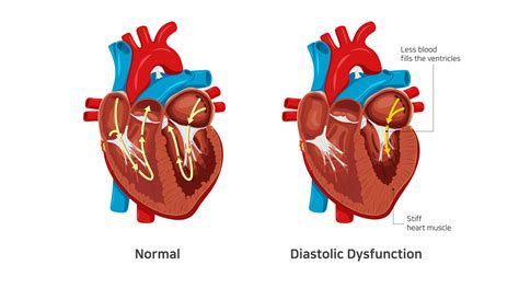 plaque lv|Left Ventricular Diastolic Dysfunction: Causes and Treatments.